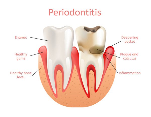 IMG-dental-consequence-GettyImages-953457706