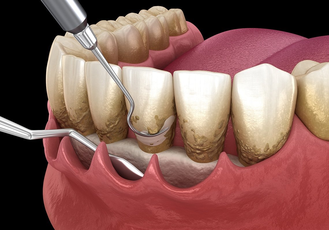 Periodontal-Therapy-In-Brisbane-2