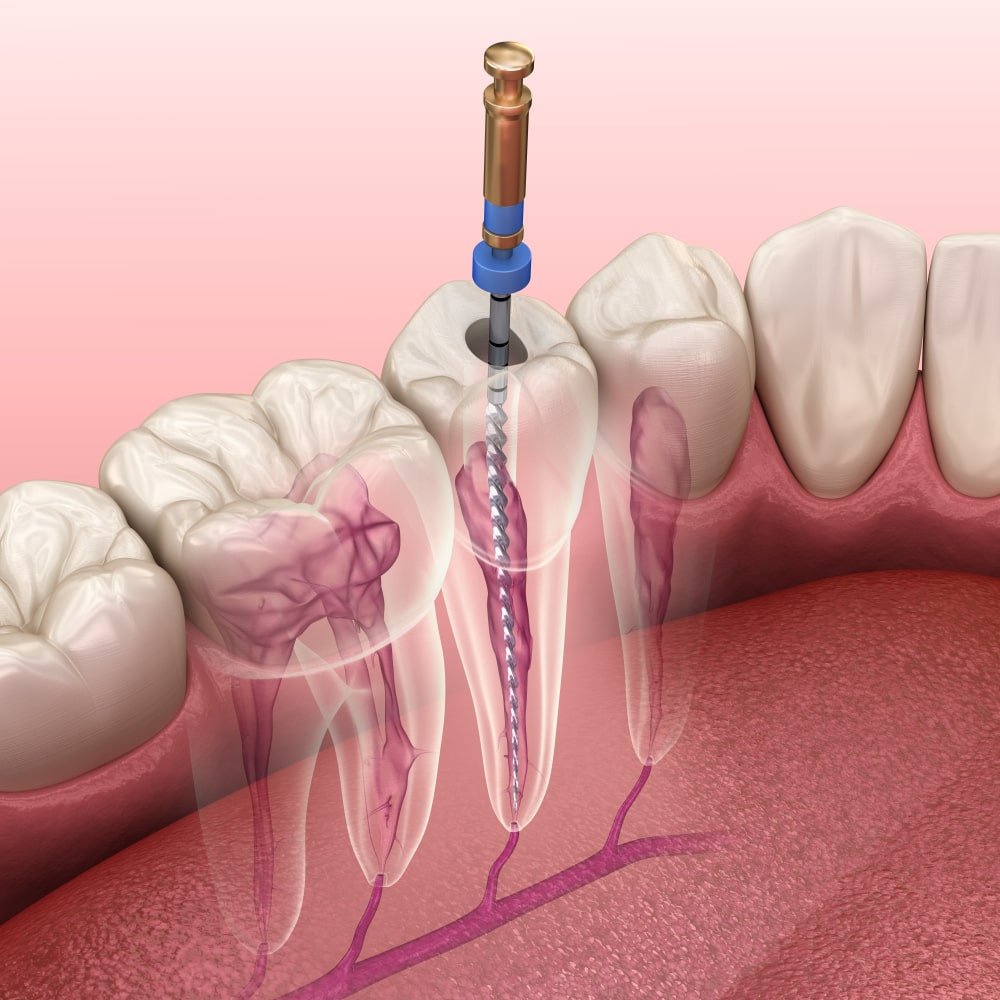 Root-Canal-Treatment