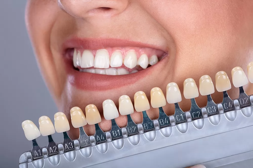 Teeth-Whitening