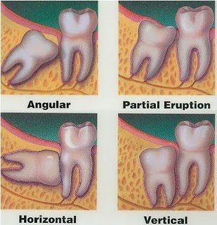 Type-of-impaction