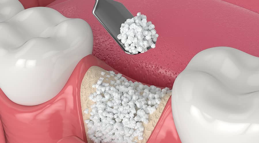 bone-grafting