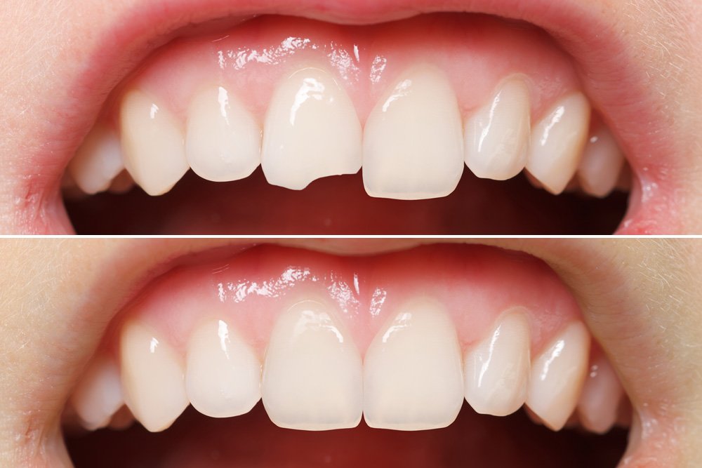 broken-chipped-tooth