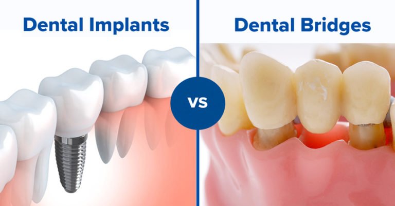 dental-bridges-vs-dental-implants-in-Thane-1