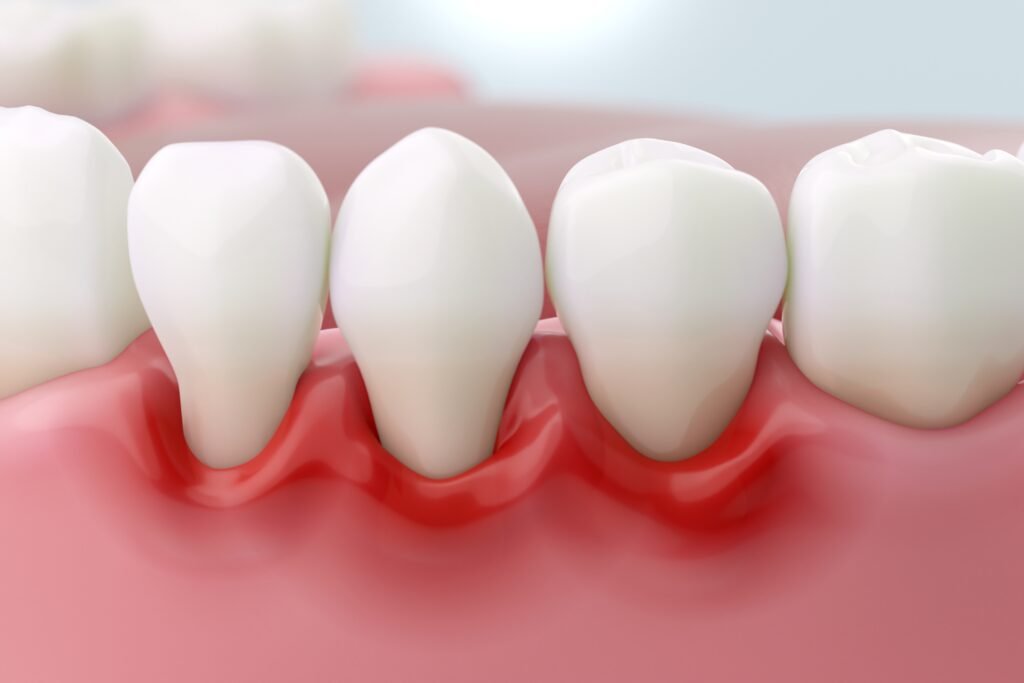 Gum,Disease,And,Inflammation,From,Periodontitis,Or,Gum,Recession.,3d