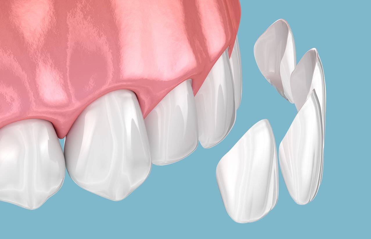 image-of-composite-veneers