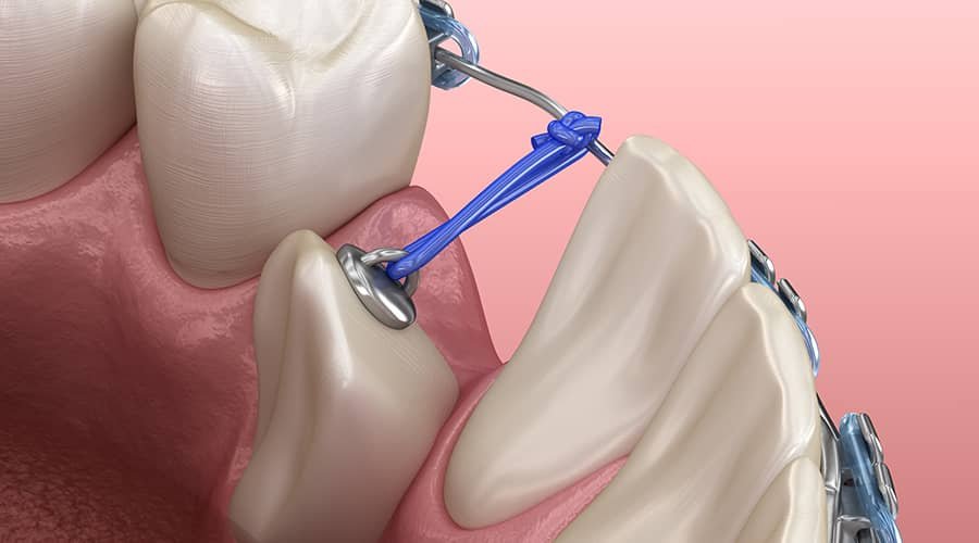impacted-canine-tooth-bracketing