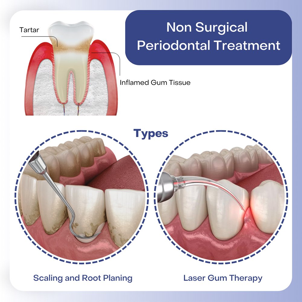 non-surgical-periodontal-treatment-nj