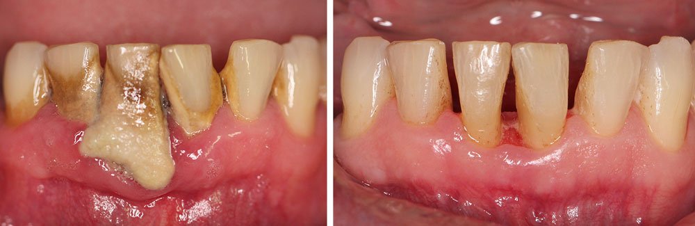 nonsurgical-periodontal-treatment