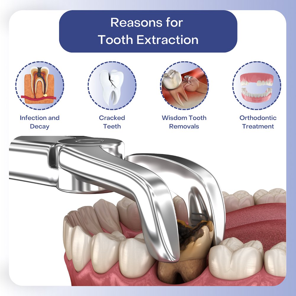 reasons-for-tooth-extraction