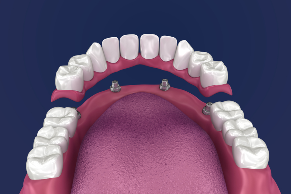 what-are-the-four-types-of-permanent-dentures-available-right-now